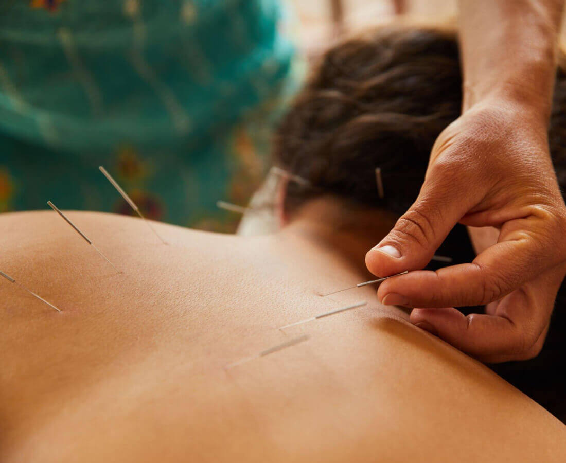 Acupuncture 